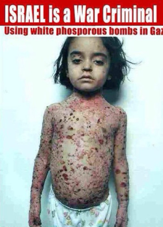 The image shows a young child with a serious expression, standing against a plain background. The child's skin is covered in severe burns or lesions. 

The top part of the image has a red banner with white text that reads, "ISRAEL is a War Criminal." 
Below that, in smaller text, it says, "Using white phosphorous bombs in Gaza." 