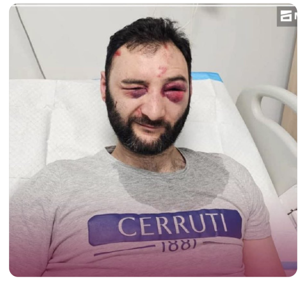 Georgian protestor in a hospital bed with severe bruising round his eyes.